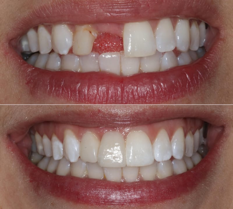 Dental bridge