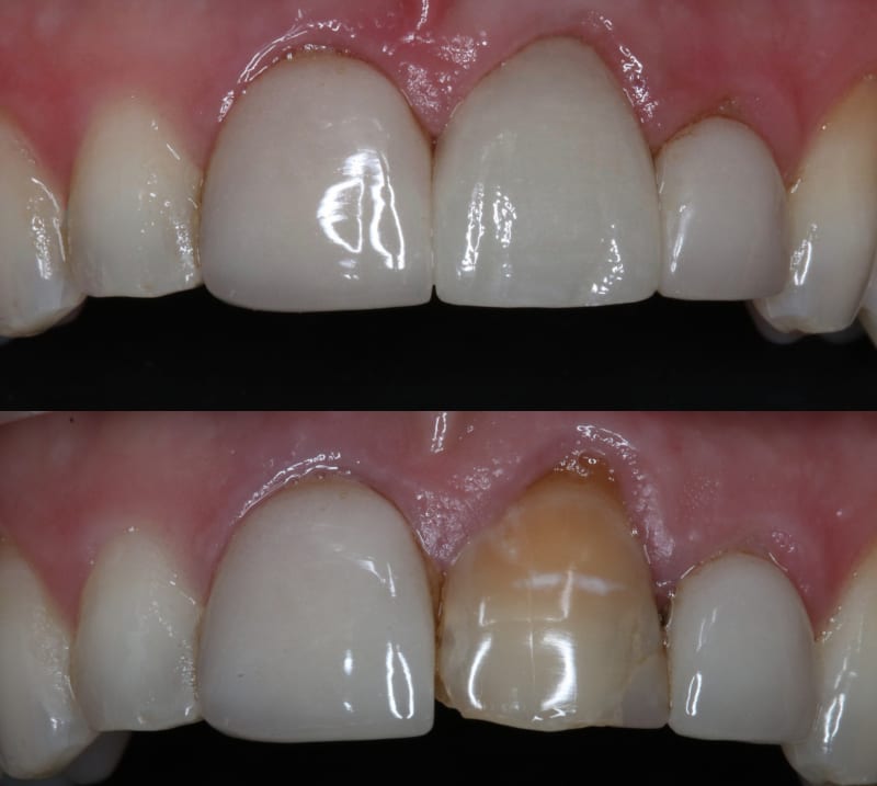 Dental crown