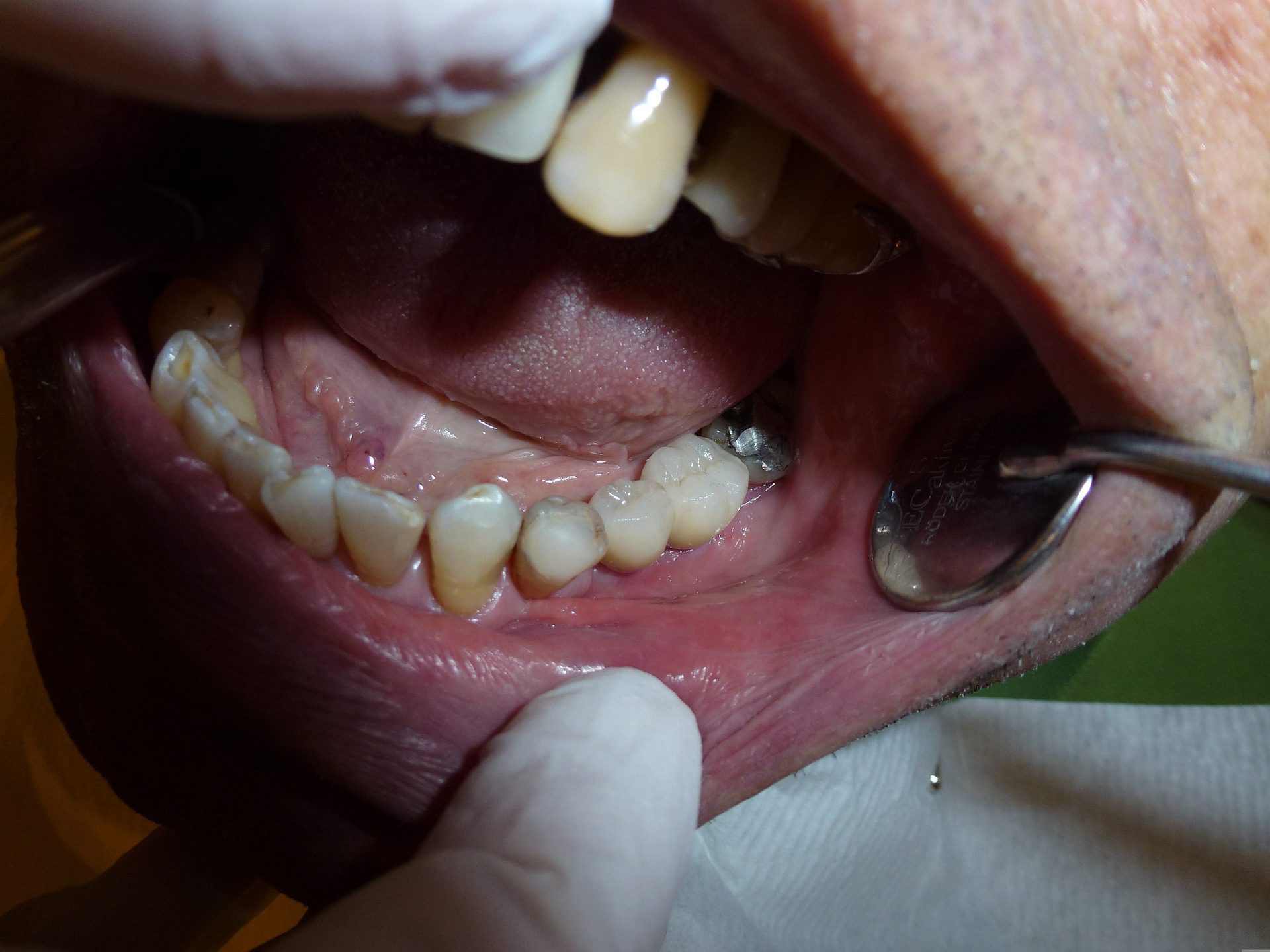 Dental restoration